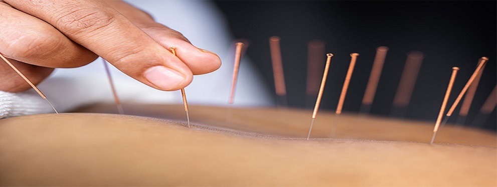 acupuncture healing naturally