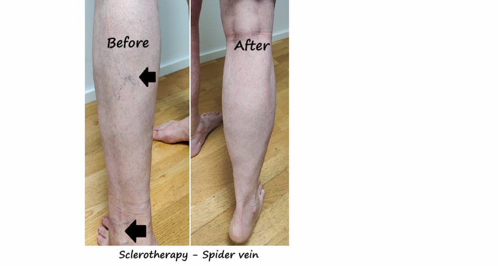 Before & after spider veins treatment Delhi – leg veins reduced 8 weeks after sclerotherapy.