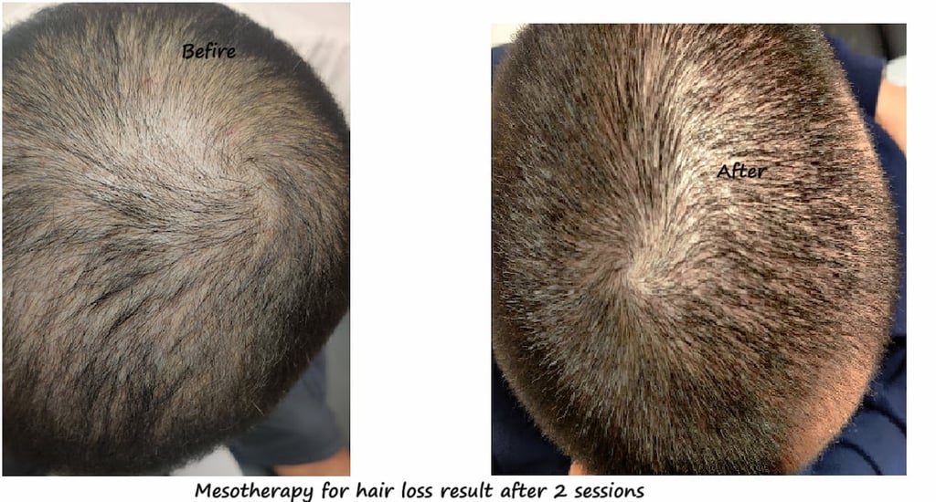 Before & after 1 session Mesotherapy Delhi – 42 yr male with hair loss, showing improved hair growth
