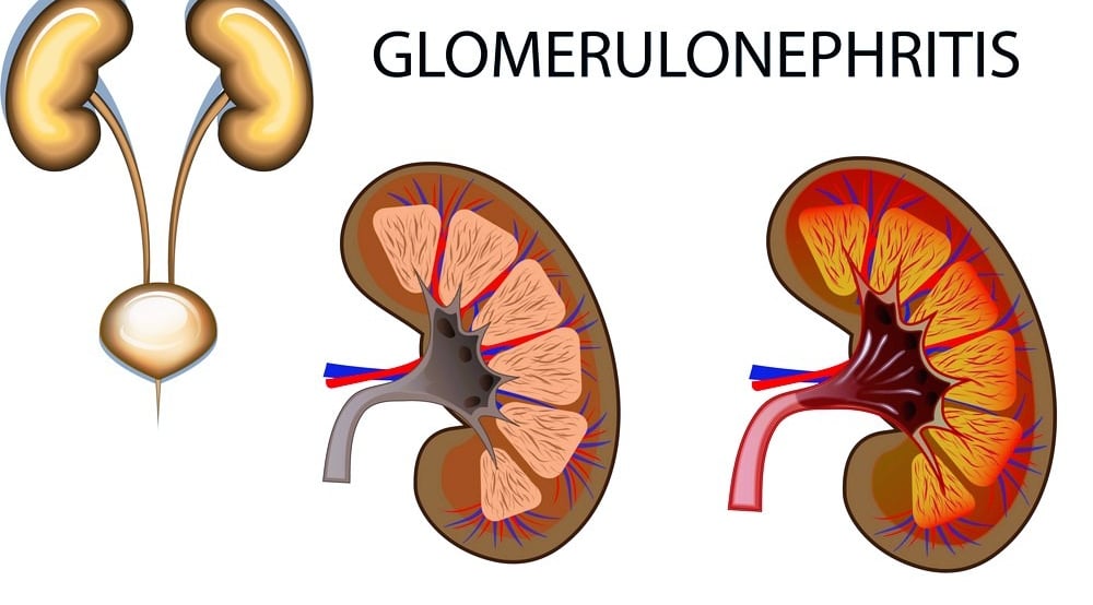 glomerulonephritis