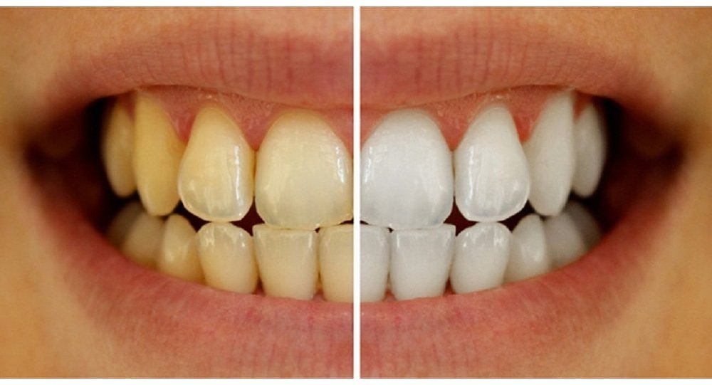 Teeth Cleaning and whitening at dentosculpt