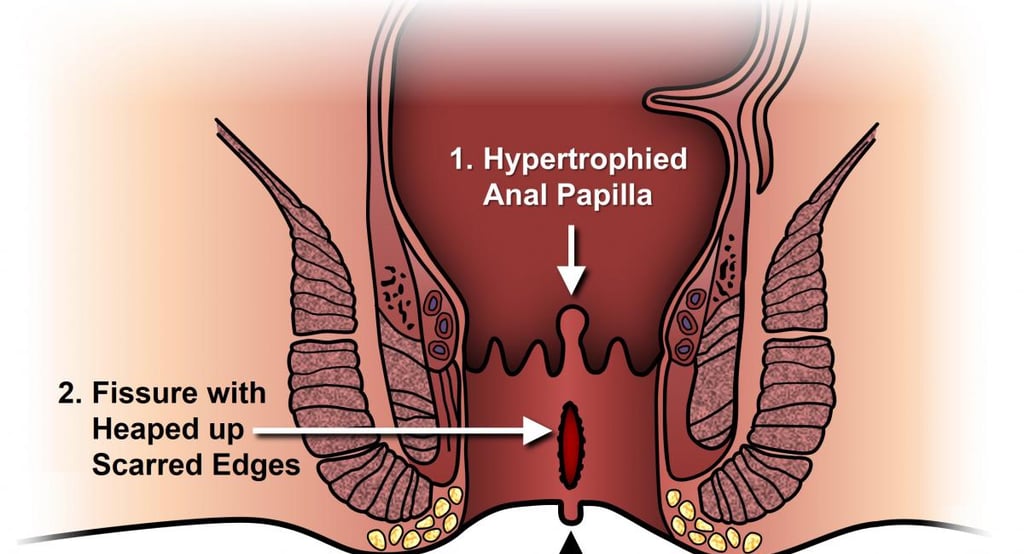 anal fissure GASTRO FOUNDATION