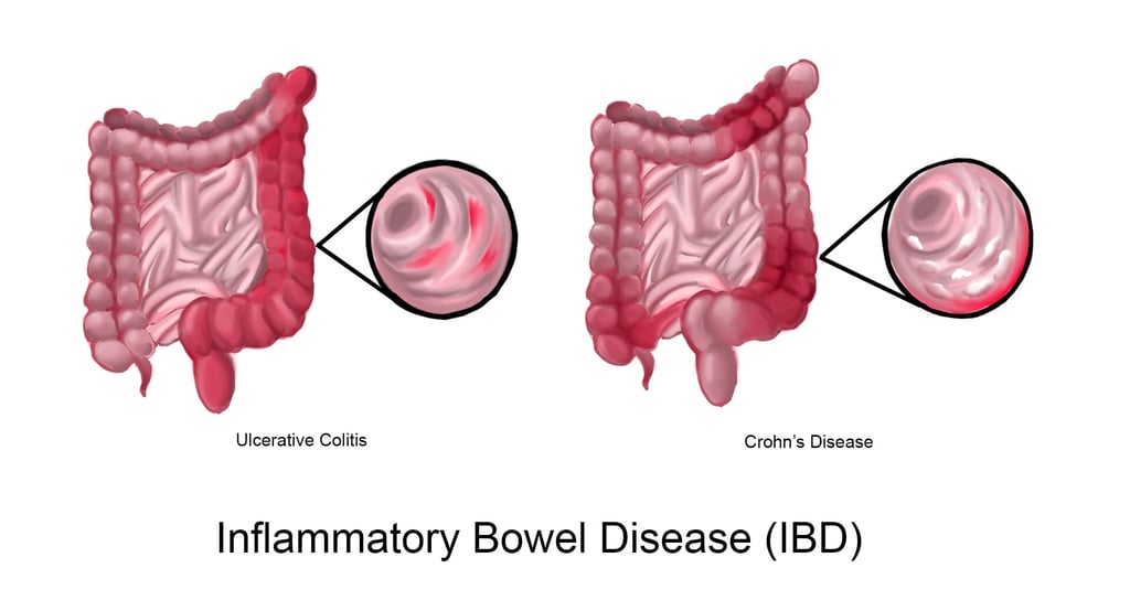 inflammatory bowel disease GASTRO FOUNDATION