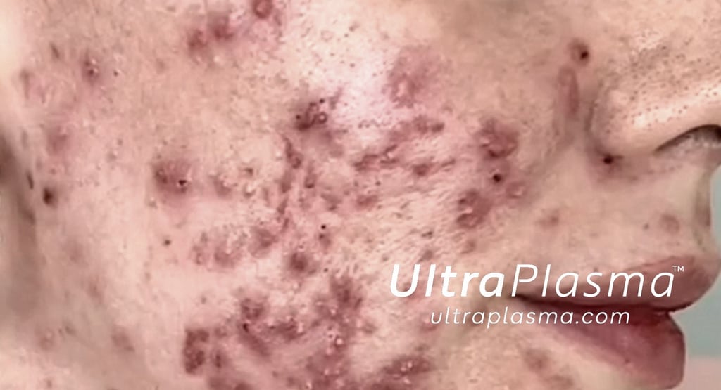akne_acne_ultra_plasma_ultra_plazma_ultra-plasma_ultra-plazma