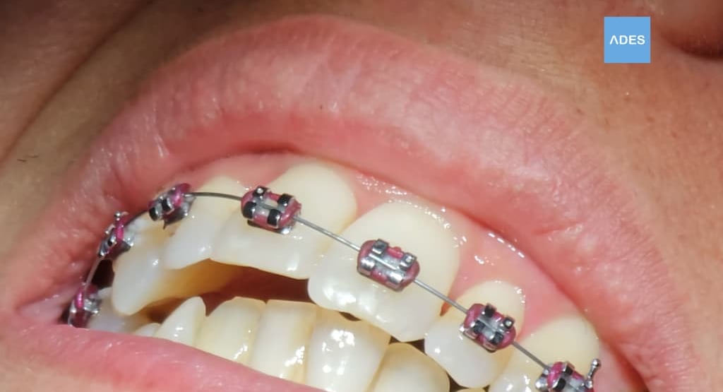 Revisión de ortodoncia en Clínica Dental ADES