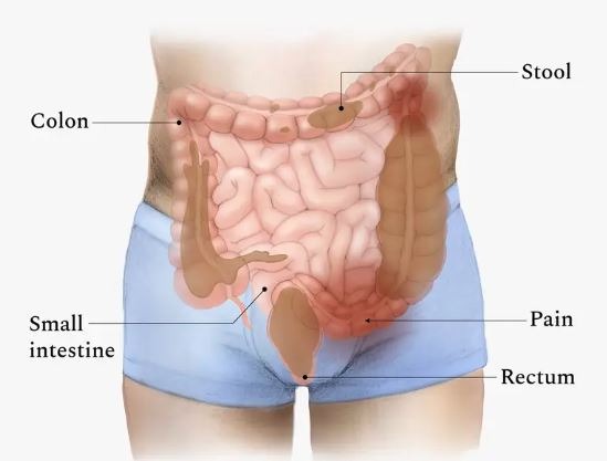 intestine (constipation)