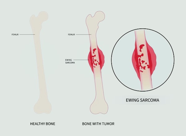 bone sarcoma cancer