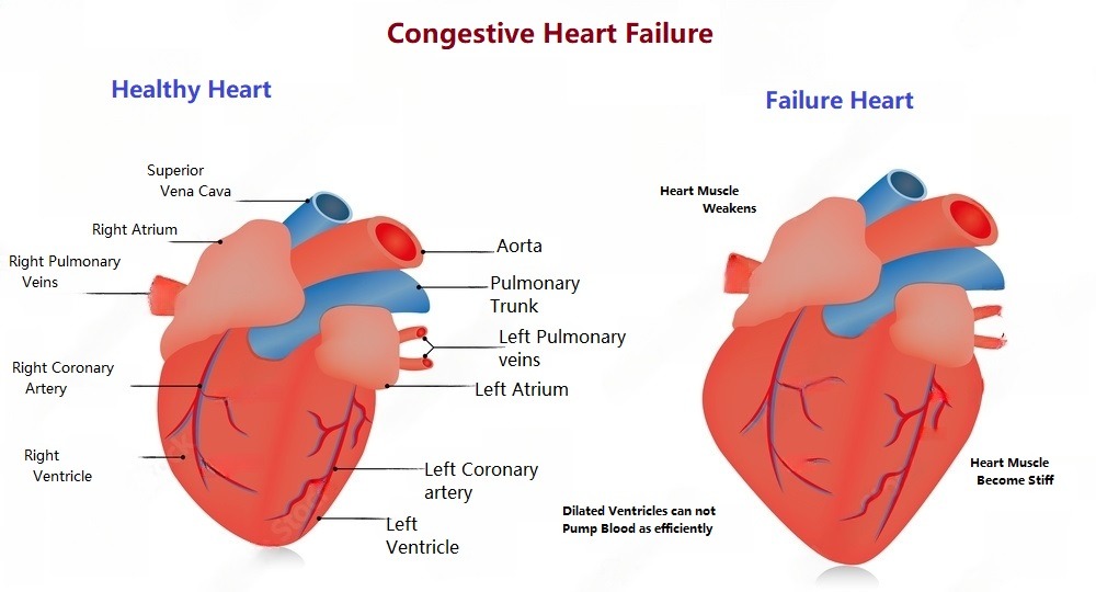 healthy and failure heart