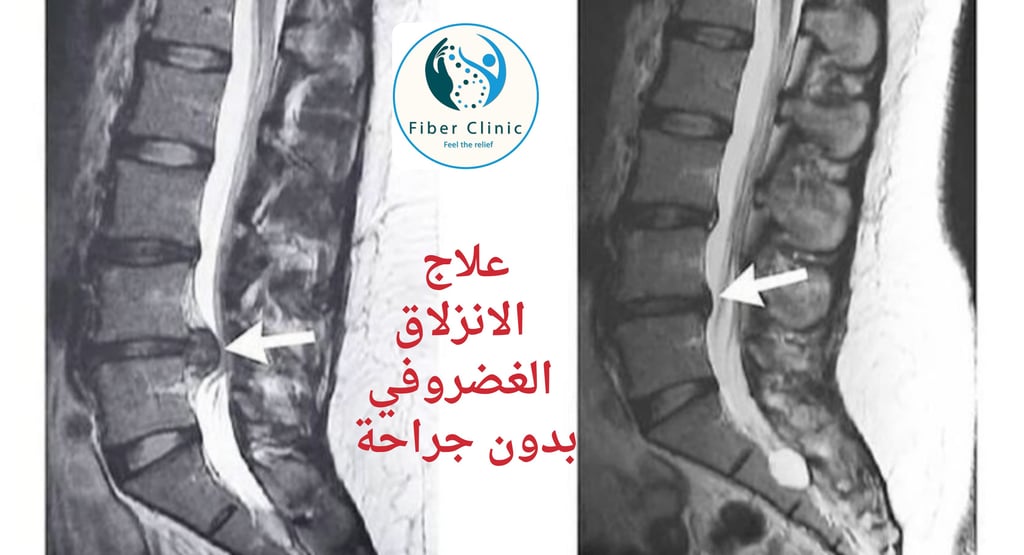 احدث طرق لعلاج الانزلاق الغضروفي بدون جراحة