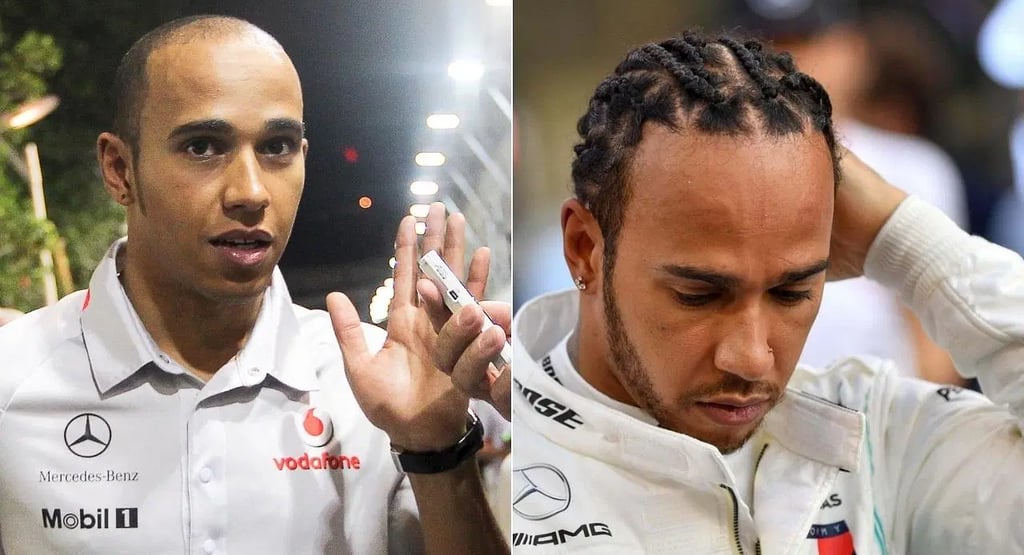Lewis Hamilton' F1 hair transplant
