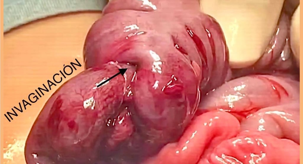 Invaginación intestinal