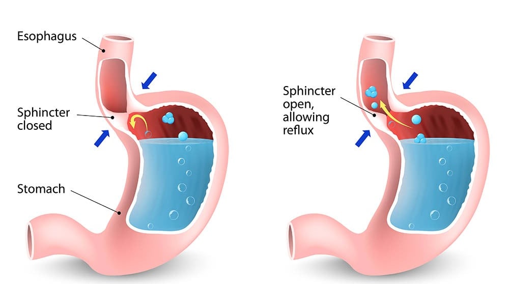 GASTRO FOUNDATION gastroesophageal reflux diseaese ,adult