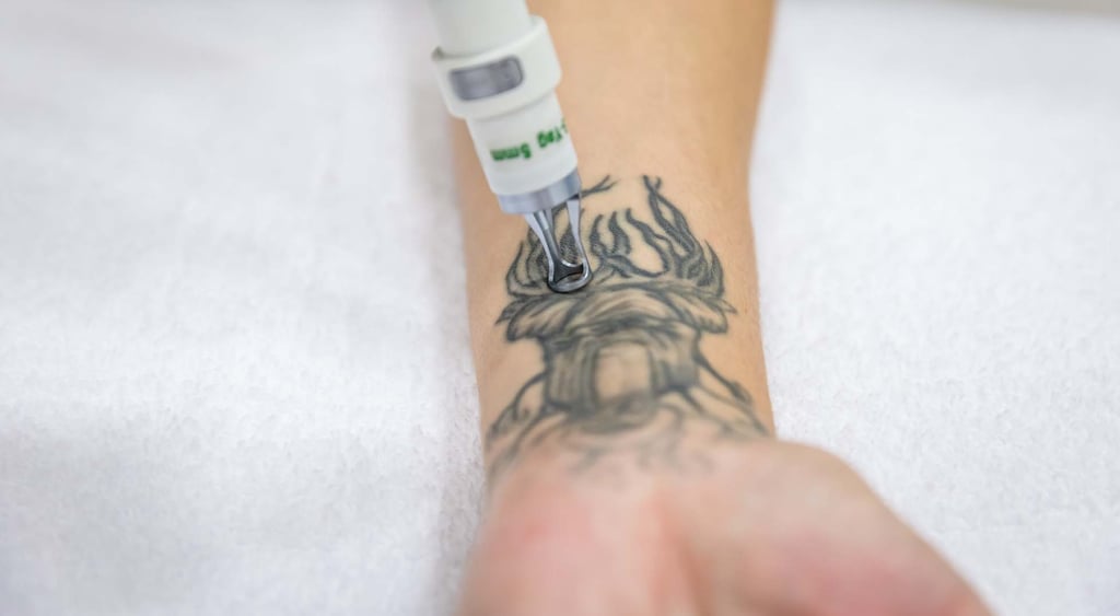 remocion laser de tatuajes