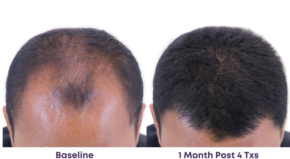bald man rejuvenated by Alma TED hair treatment within 4 treatments