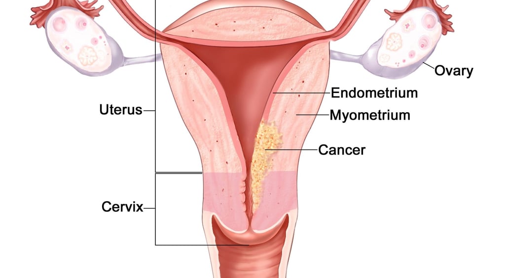 Endometrial Cancer