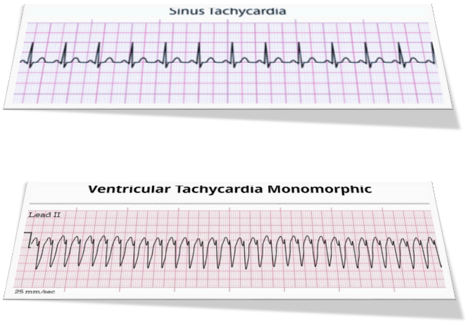 tachycardia