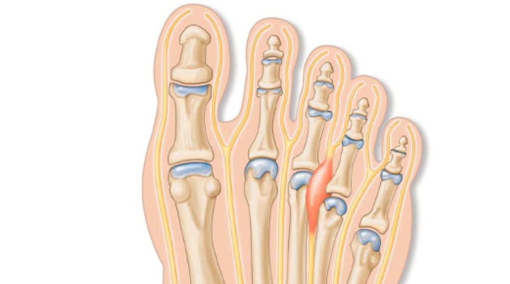 neuroma de morton, morton, inflamação do nervo, dor no pé