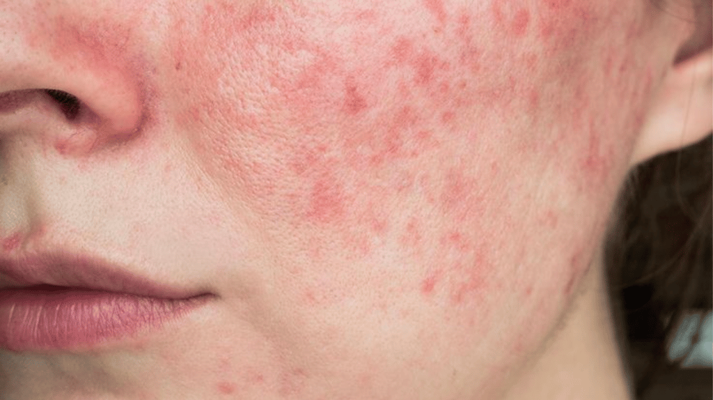 Da bị burn-out do lạm dụng treatment