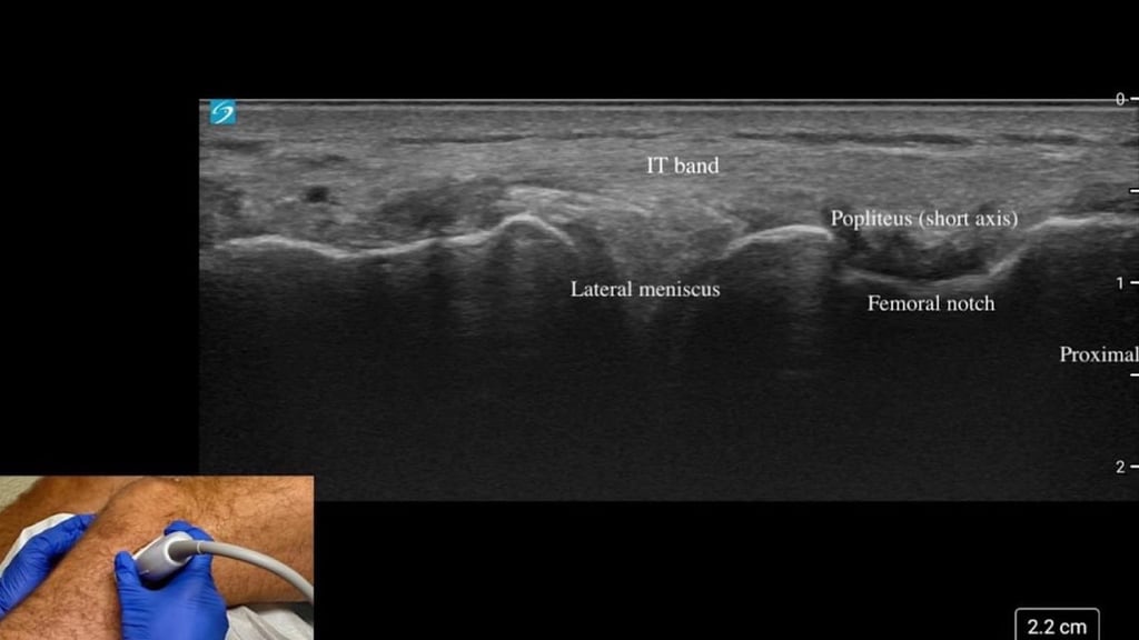 echographie genou diagnostic gonflement genou