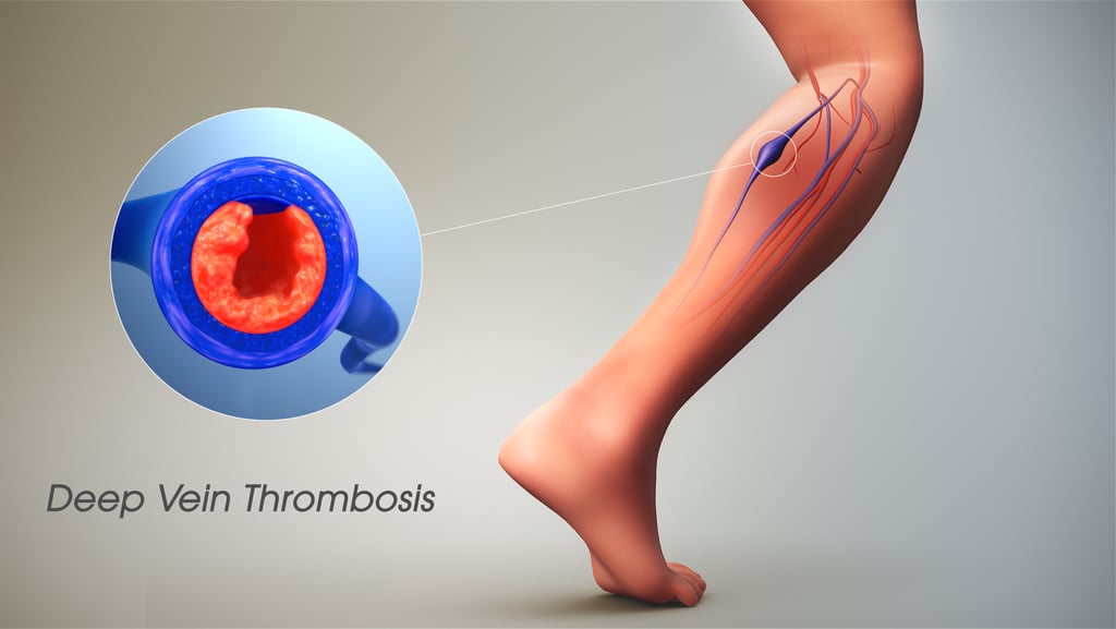 vascular ultrasound blood clot deep vein thrombosis leg swelling thinner anticoagulant embolism pain doppler factor v leiden