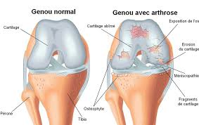 arthrose genou