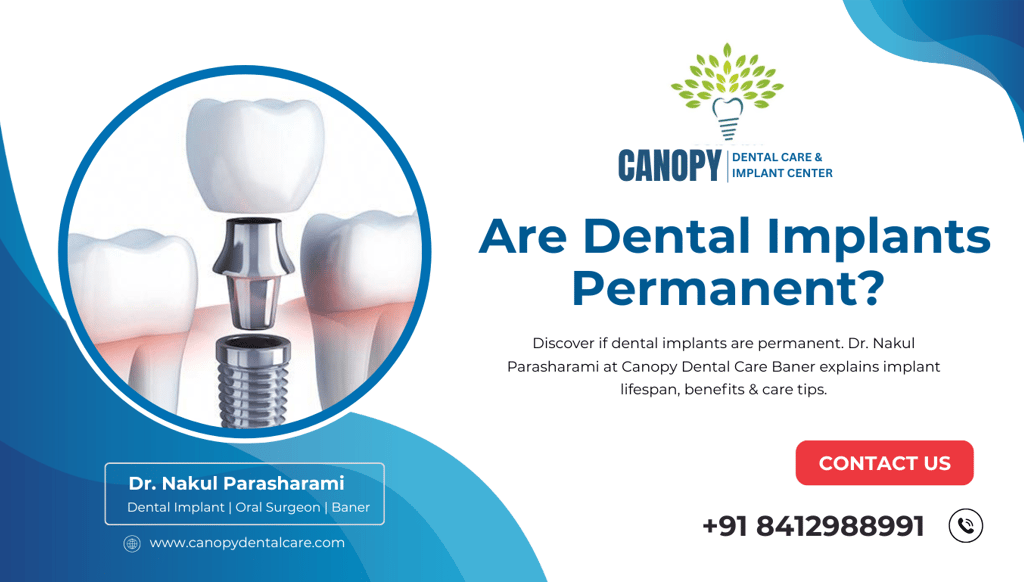 Top Dental Implants in Baner