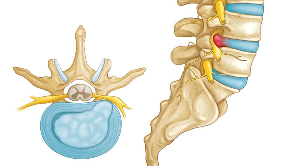 hernia de disco, hernia discal, dor na coluna, ciático