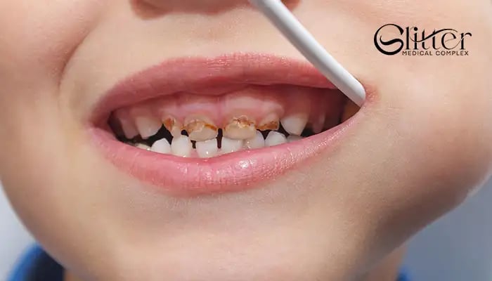 أفضل طرق علاج تسوس الأسنان للأطفال