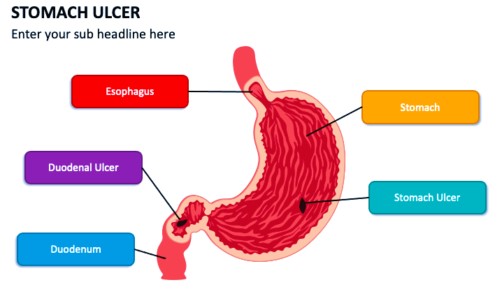 ulcer
