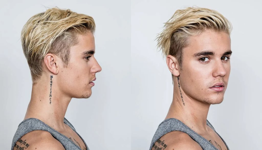 justin bieber hair transplant