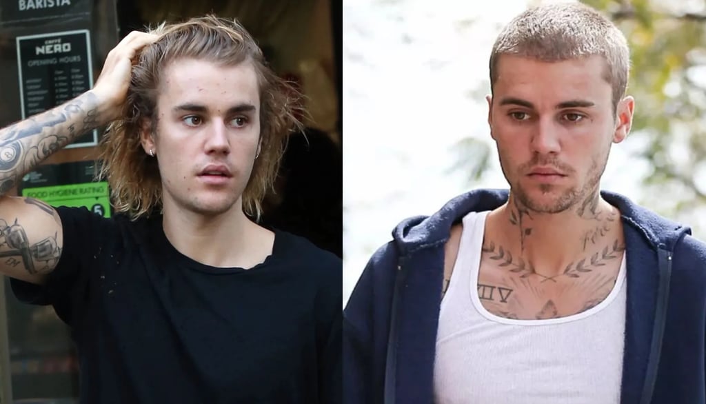 justin bieber hair transplant