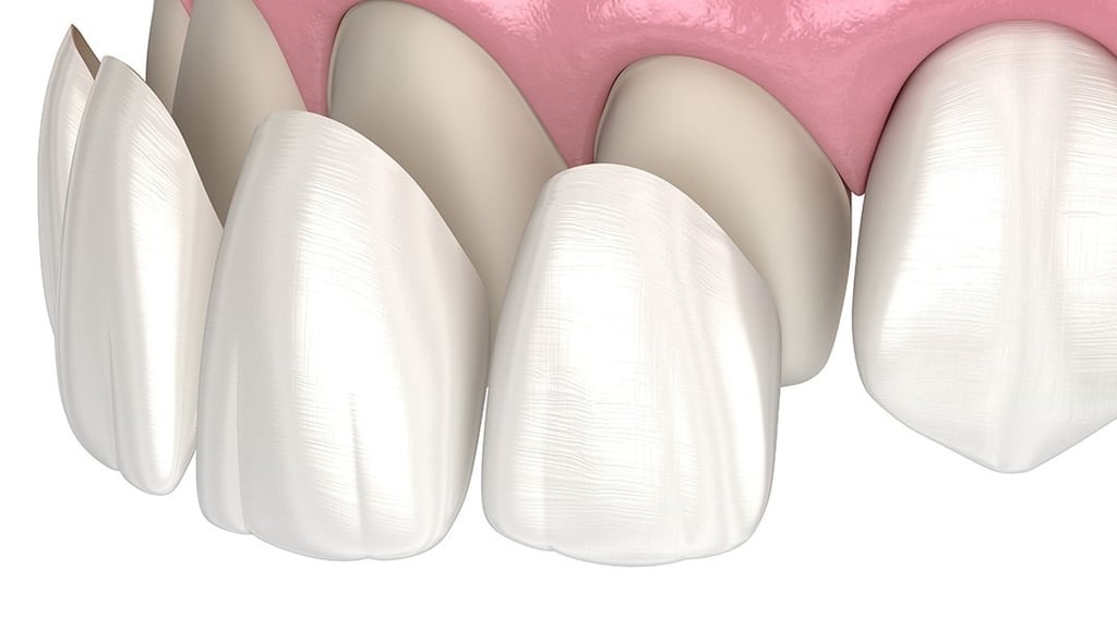 Faccette dentali
