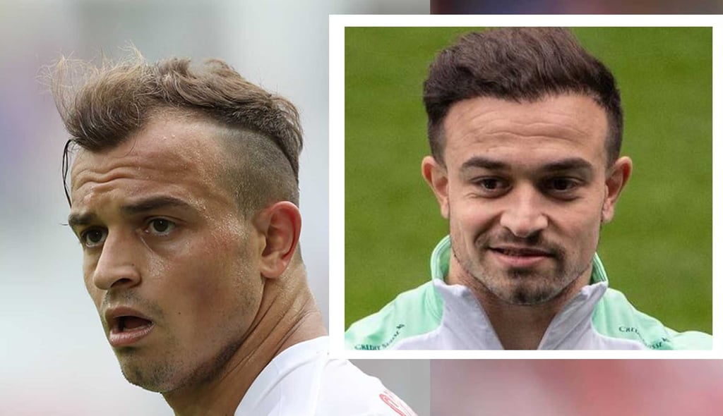 Xherdan Shaqiri hair transplant