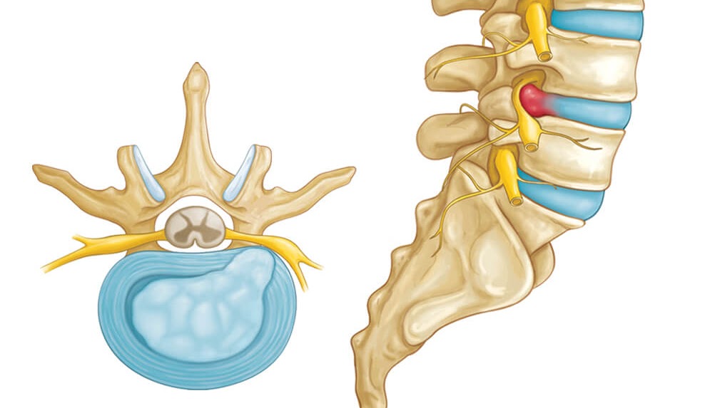 hernia de disco, hernia discal, dor na coluna, ciático