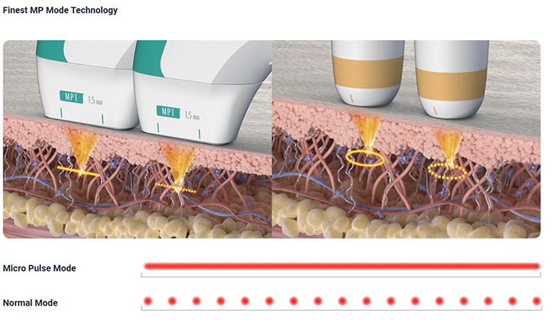 Ultraformer MPT HIFU Singapore Clinic