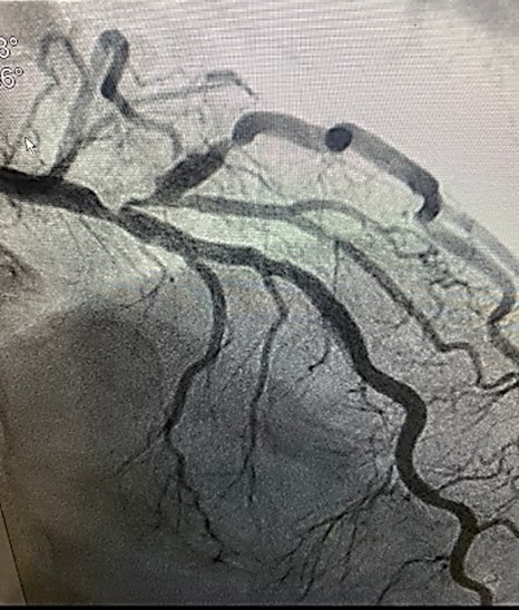 a heart with a vein vein on the left side of the heart