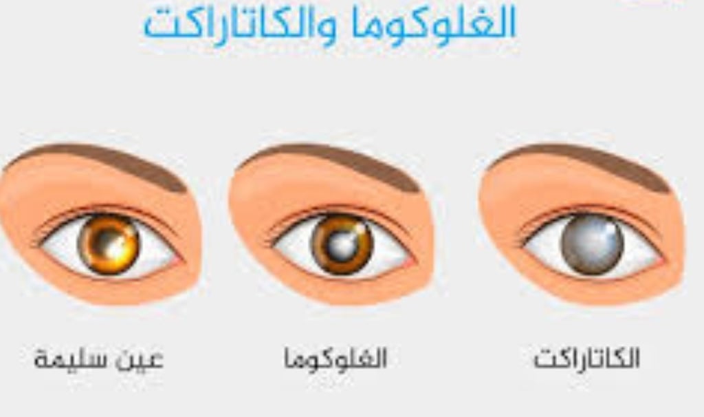 الجلوكوما : خيارات العلاج