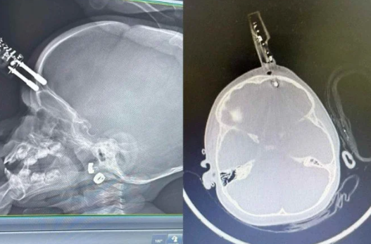 Carregador fica preso no crânio de bebê - (crédito: Cedido ao Correio)