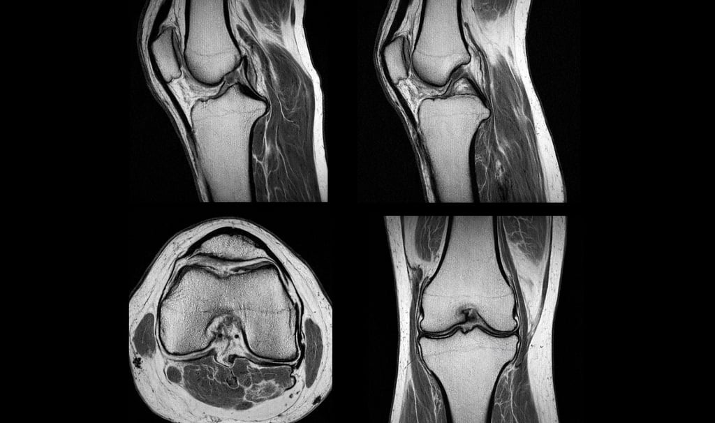 IRM genou menisque lesion