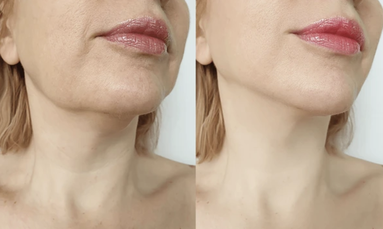 Harmonização do contorno facial com preenchimento de mandíbula na clínica médica e estética em Setúb