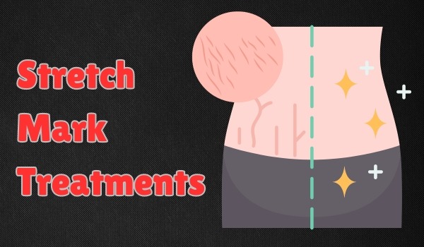 Stretch Mark Treatments