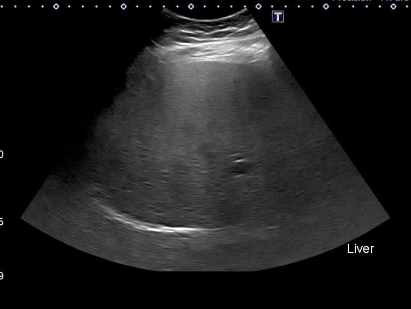 R/O Fatty liver ultrasounds in Luxury T & Ultrasoud Center, hialeah fl