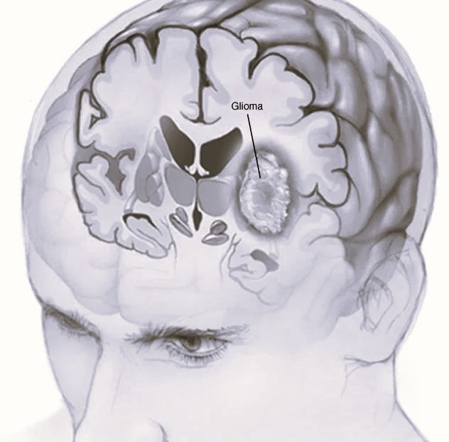 Glioma