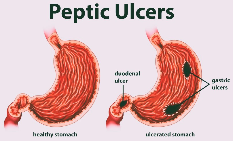 peptic ulcers