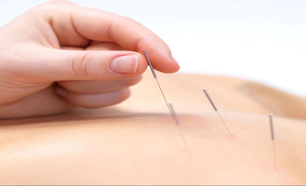Acupuncture being performed on the back for pain relief