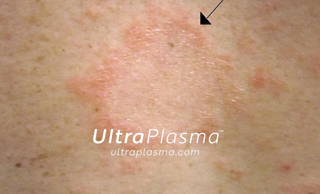 ultraplasma.com_Pityriasis_Rosea_treatment_ultra_plasma_ultra_plazma