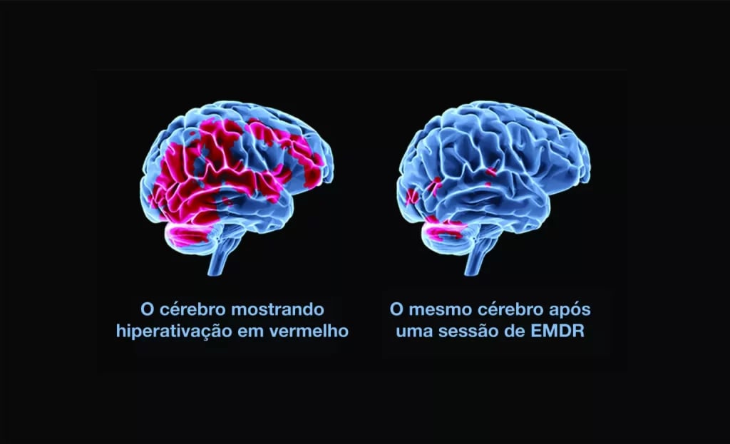  Comparação tridimensional do cérebro antes e depois de EMDR, mostrando redução de hiperatividade.
