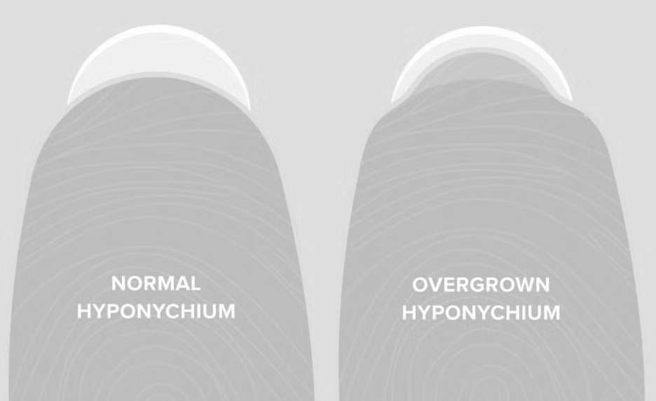 Overgrown hyponychium