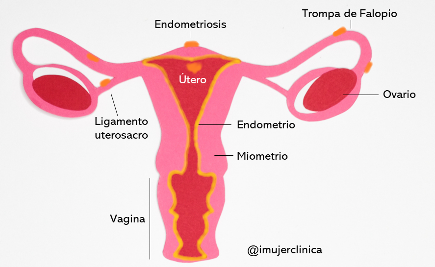 Endometriosis endometrio ovario trompa de falopio imujer ginecología murcia ligamento uterosacro