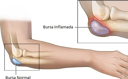 bursite, dor da bursa, bursa, dor articulação